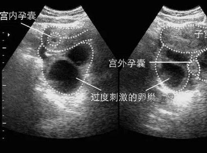 试管婴儿医院成功率排名是怎样的？试管婴儿医院哪家好？